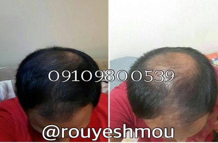 پایانی بر ریزش مو - 1