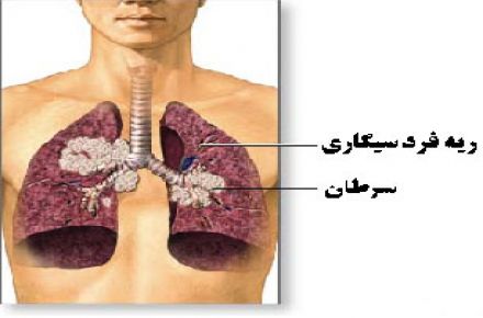 دکتر فرید عزیزی فوق تخصص ریه - 1