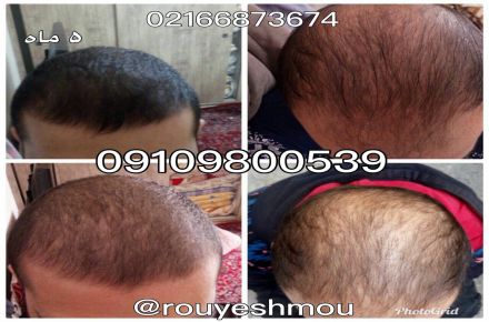 رشد مجدد مو با محلول دکتر نوروزیان ممکن شد - 1