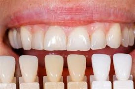 مراحل ترمیم لمینیت دندان | مراحل ترمیم کامپوزیت ونیر| بهترین دندانپزشک زیبایی - 1