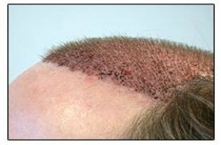 کاشت ترمیم مو پروتز موی طبیعی چسب ترمیم مو - 1