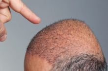 کلینیک تخصصی پیوند مو