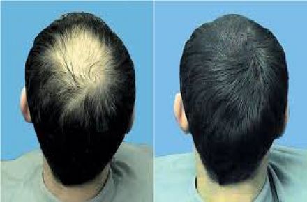 مرکز کاشت موی طبیعی پارس - 1