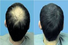  پر کردن پستیژهای خالی ترمیم مو 