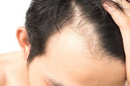  کاشت تخصصی موی طبیعی با روش جدید امریکایی TS، ترکیبی، Fut، Fit  - 1