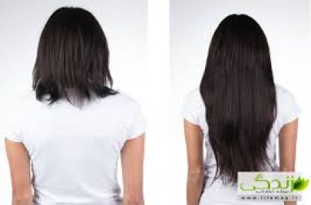 پیوند موی طبیعی وقابل رشد(مهنیا) - 1