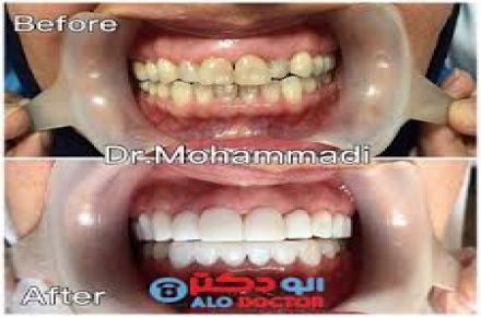 مرکز دندانپزشکی لبخند (کامپوزیت نانو سرامیکی) - 1