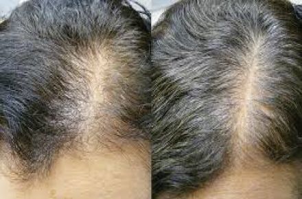 درمان ریزش مو و کم پشتی آن - 1
