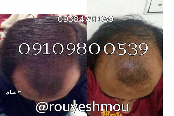 مقایسه دیگر محلول های رشد مو با محلول دکتر نوروزیان