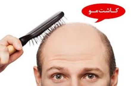  کاشت موی تخصصی تهران